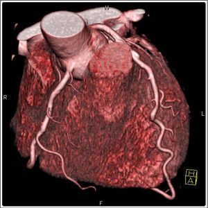 3D image of the heart during a CT examination
